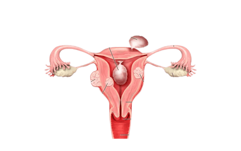 Fibroids
