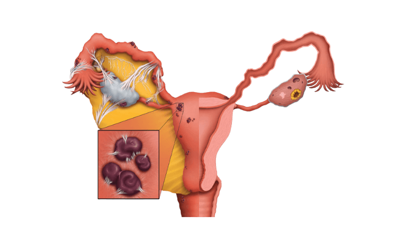 Endometriosis