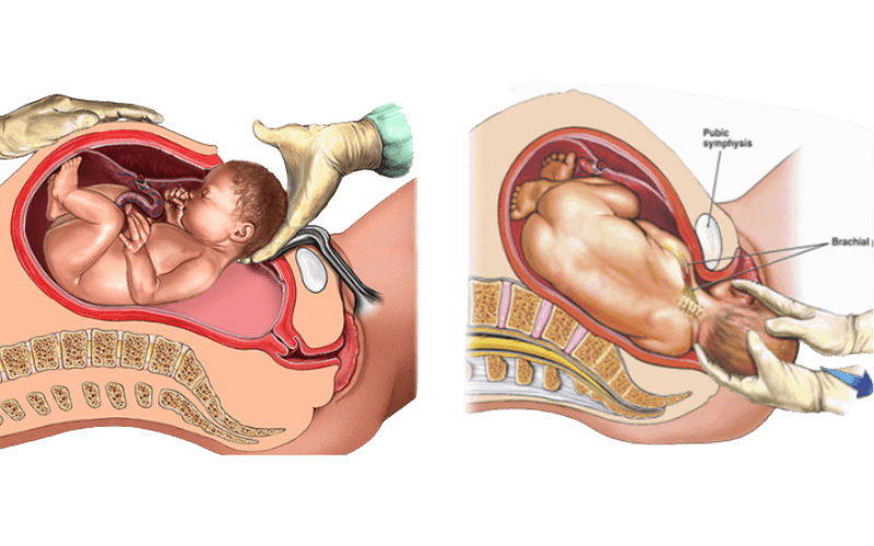 Normal & Caesarean delivery