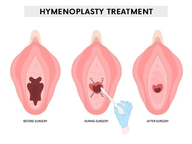 Hymen Repair (Hymenoplasty)
