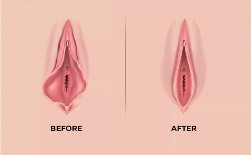 Surgical Tightening (Vaginoplasty)